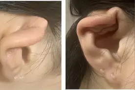 打耳洞引发耳廓感染？耳朵哪个部位不能打洞？上海专家在国际顶级医学期刊发表临床病例报道图片