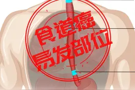 体内有癌，喉咙先知！出现这4种症状，可能是食道癌来袭图片