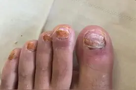 灰指甲竟然这么简单就能好，害我白折腾好几年！图片