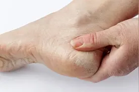 脚后跟干裂起皮，除了缺乏维生素，还有这几大原因，别再视而不见图片