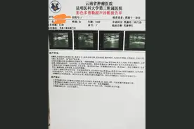 乳腺纤维瘤进行微创手术时B超提示钙化包膜不完整可能是恶性肿瘤图片