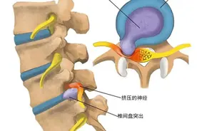L5或S1椎间盘突出、硬膜囊受压，什么意思？很严重吗？图片