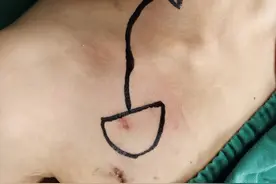 安全便捷的输液港图片