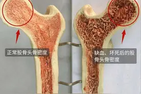 股骨头坏死的预防和治疗图片
