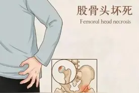激素是导致股骨头坏死的罪魁祸首图片
