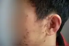 关于Hunt综合征，你了解多少？图片