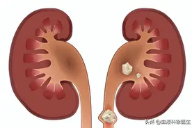 体检查出肾结石怎么办？医生：2个方法，或能让肾结石离开身体图片
