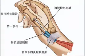 腱鞘炎有哪些常见症状和预防的方法？图片