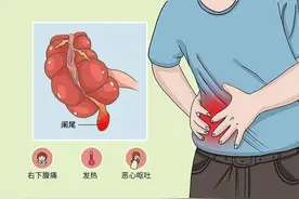 阑尾炎是怎么样引起的？预防、诊断和治疗方法大全！图片