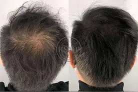 SMP纹发'毛囊渲染色料，为头皮量身定制，为亚洲人研发的纹发色料图片