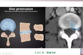椎间盘突出的CT及MRI诊断！5分钟学会图片