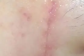 7种常见疤痕，你是哪一种？图片