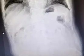肛门口一直流粪水，不一定是“大便失禁”，可能是“粪嵌塞”图片
