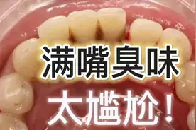 牙结石口臭注意了！教你在家就能解决的方法，学会终身受益！图片
