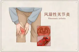 迁延不愈的风湿病痛该如何治疗和缓解？图片