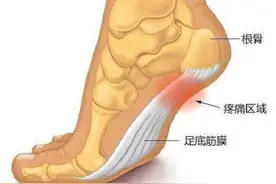 足底筋膜炎：你必须要接受的几个事实图片