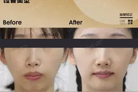 正畸三年堪比手术，“消失”的下巴终于回来了！！！图片