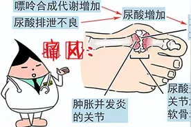 陈医生：痛风加重前有征兆，别再傻傻地等到加重后才开始 后悔图片