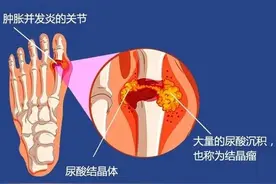 何为痛风？原因又从何而来？图片