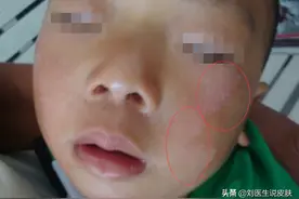 只用三四天，白斑便从腋下长到后背，这是啥病啊？医生告诉你真相图片