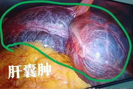 肝囊肿是什么，如何治疗？图片