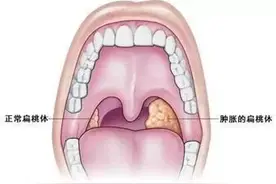 急性扁桃体炎的药物治疗，你掌握了吗？图片