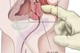 陈医生带你了解前列腺炎之“前列腺按摩”篇图片