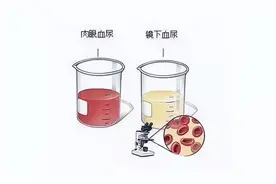 小便带血？别急，让我们从3个原因，分析这件事图片