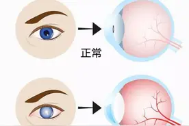 身体的密信：眼睛揭示癌症和健康秘密！三个不容忽视的惊人信号！图片