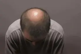拿什么来拯救你，“秃如其来”的脱发，不妨试试这么做图片