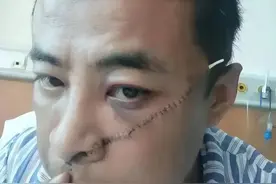 因狂挨揍？网红济南大肠哥发布被打照片，脸上留下一道长长的刀疤图片