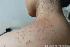肩颈脸上大腿脖子后面长痘痘一碰就疼怎么根治？图片