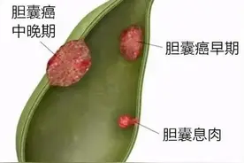 胆囊切除了有哪些后遗症？这3种症状很常见，万不得已别切图片