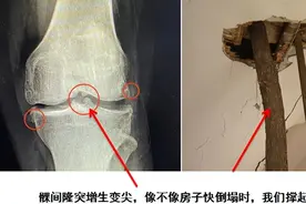 骨质增生并不是一无是处，请不要再误解它了图片