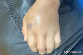 尿酸高的根本原因是什么？图片