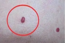 身体突然出现小红点，是疾病来临的信号吗？建议了解图片