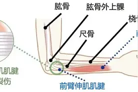 肘部外侧疼痛？网球肘的病因、症状、治疗图片