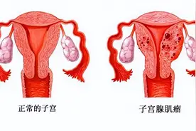 女性为什么容易长子宫肌瘤？建议：平时尽量避免4个行为，别大意图片