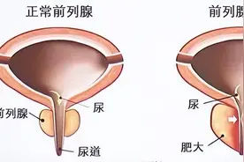 男人的生命“腺”——前列腺增生了怎么办？图片