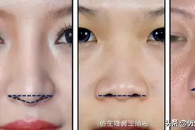 如何定义短鼻，短鼻延长后的改变有多大？图片