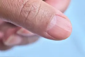 科学解释：指甲若出现4种症状，可能是癌或疾病的征兆，留心观察图片