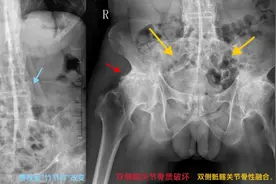 磁共振检查可检出早期强直性脊柱炎！警惕不明原因腰背部疼痛图片