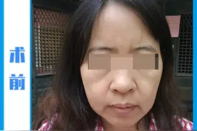 48岁把拉皮做了，没做美颜加工! 术后16天、79天、120天像换一张脸图片