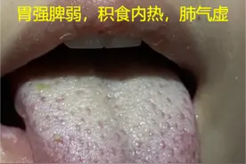 每日舌诊分析——胃强脾弱，脾气下陷，前列腺，失眠，阴阳两虚图片