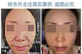 50、60岁大姐做拉皮手术实拍，术后28天颜值逆袭，换脸成功图片