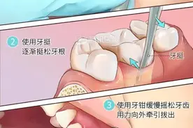 #拔牙图片