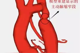 15岁少年血压高达170，被细心专家查出原因图片