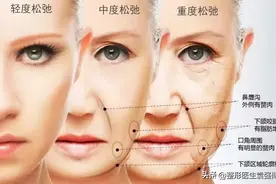 整形医生给40岁后女性的一份抗衰老方案（简单实用）图片