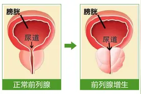 4个好方法，教你保养好前列腺图片