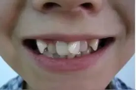 孩子牙齿不齐，这个年龄段做牙齿矫正，面型改善的效果更好！图片